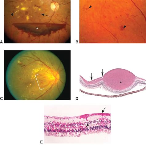 Eye Hemorrhage Anatomy