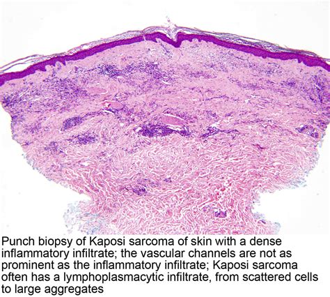 Pathology Outlines - Kaposi sarcoma