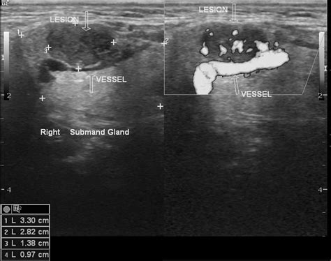 Salivary gland tumor ultrasound - wikidoc