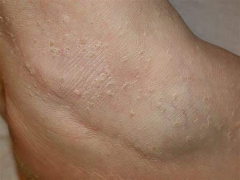 stucco keratosis - pictures, photos