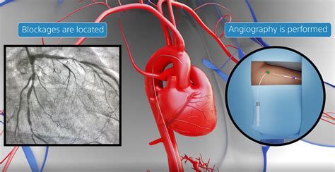 Know Ur Heart The Coronary Circulation - vrogue.co