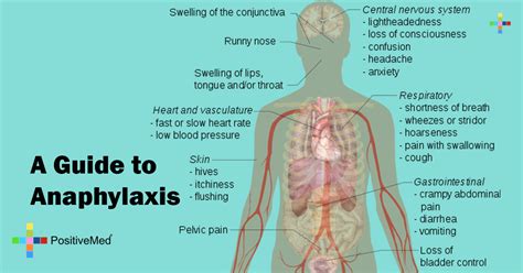 A Guide to Anaphylaxis