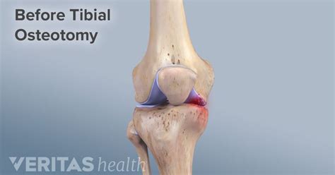 Knee Osteotomy Risks and Complications | Knee osteoarthritis, Knee ...