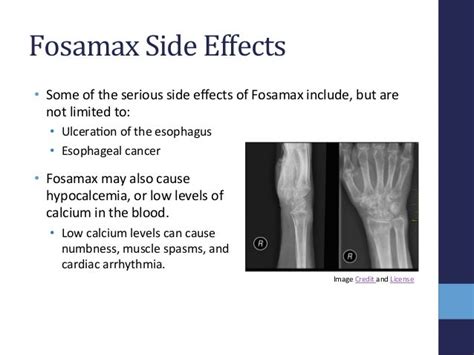 Fosamax