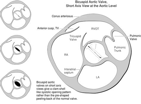 Bicuspid aortic valve - Child Heart Specialist