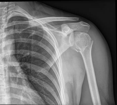 Shoulder Fracture Physiotherapy