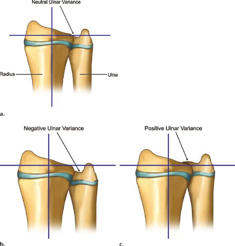 Radial Versus Ulnar Loop