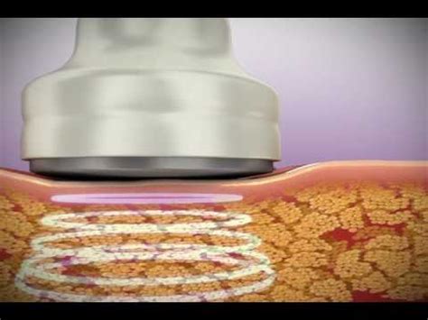 Ultrasonic Cavitation - Southern body sculpting