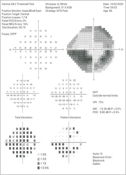 Visual Field Test – Visual Field Testing - Glaucoma Diagnosis