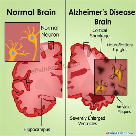 Why Do Brain Cells Die In Alzheimer Patients - Dementia Talk Club