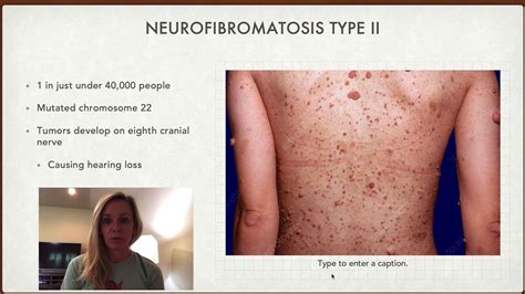 Neurofibromatosis - YouTube