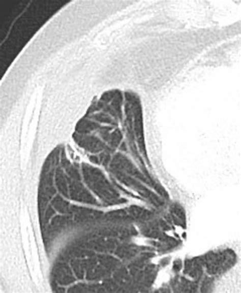 Round atelectasis | Image | Radiopaedia.org