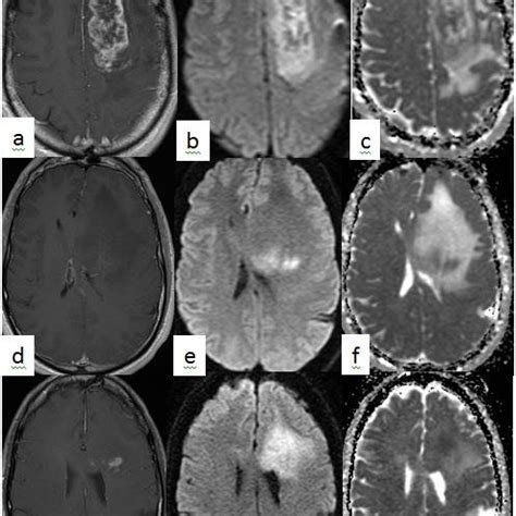 , imaging, treatment and survival characteristics of the GBM patients ...