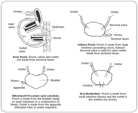 Seeking Healthy Life: What is a Urostomy Surgery? – Types of Urostomy