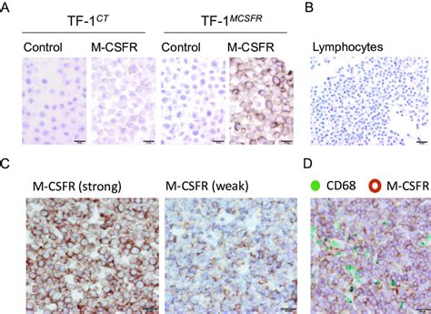 IHC for M-CSFR. IHC for M-CSFR was performed with cell block specimens ...