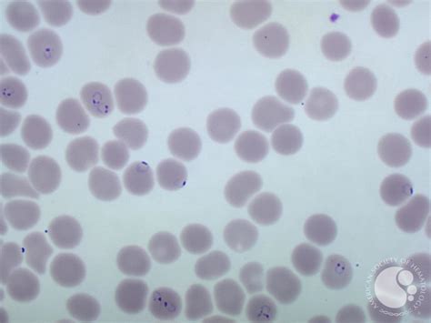 Severe Malaria Blood Smear