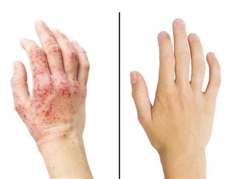 Peeling Skin: Causes, Symptoms, Diagnosis And Treatment - Boldsky.com