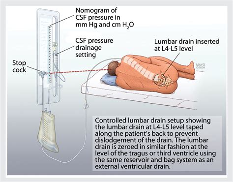 Figure 3-4 from Management of Intracranial Pressure. | Semantic Scholar