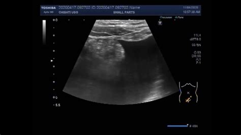 Ultrasound Video showing Mesenteric lymphadenitis also called enlarged mesenteric lymph nodes ...