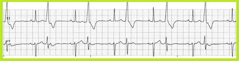 Float Nurse: Practice EKG Strips