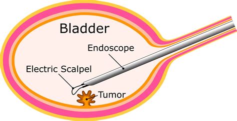 SBI Pharma | Bladder Cancer Treatment Methods | ALA