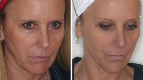 Sculptra Injections | Sculptra Treatment | Sculptra Side Effects