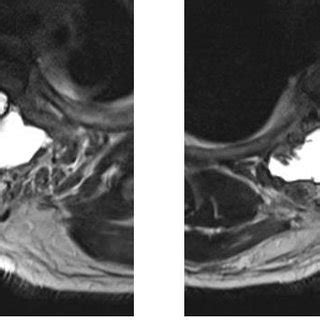 Immediate Post-operative MRI image shows Pseudo meningocele with cord... | Download Scientific ...