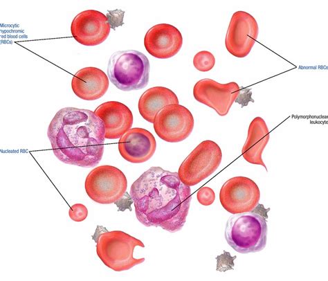 Pathophysiology Of Alpha Thalassemia