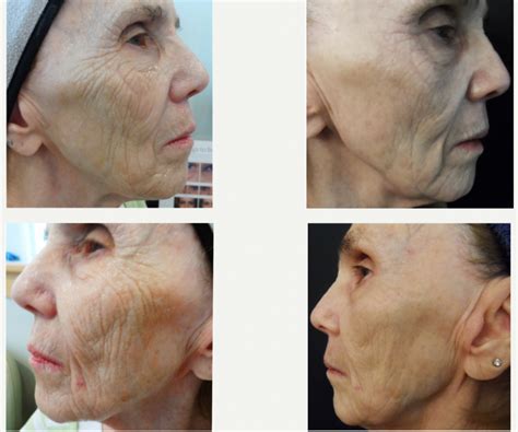 Microneedling before and after photos