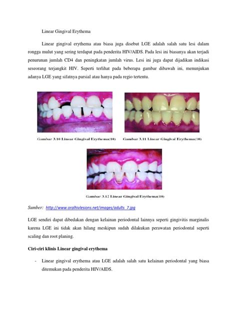 Linear Gingival Erythema | PDF