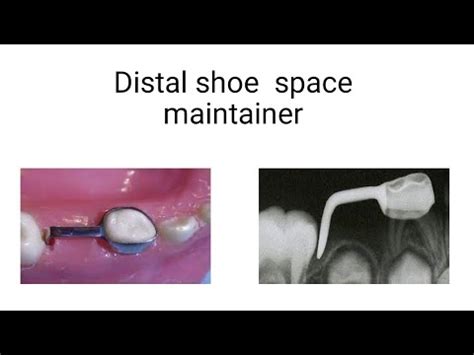 Distal shoe space maintainer - YouTube