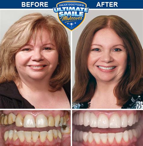 Smile Makeover Contest Winner - Debra - Cosmetic Dental Makeover