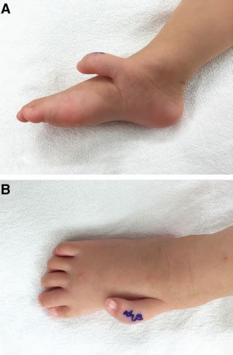 Surgical Reconstruction Technique of Two Patients With Tarsal Type ...