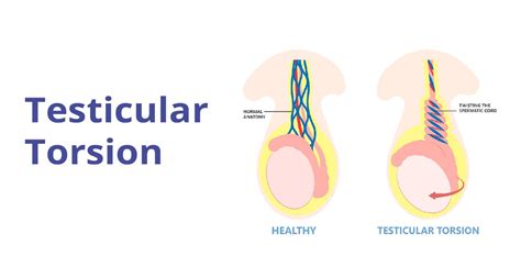 Testicular Torsion: Causes, Symptoms, Diagnosis & Treatment | Birla Fertility & IVF