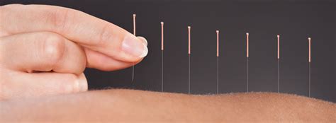 Benefits of Acupuncture for Back Pain - Long Island Spine