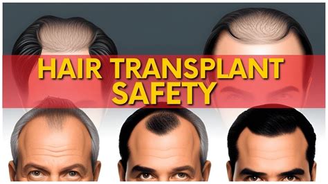 Side Effects of Hair Transplant | Hair Transplant Side Effects - YouTube