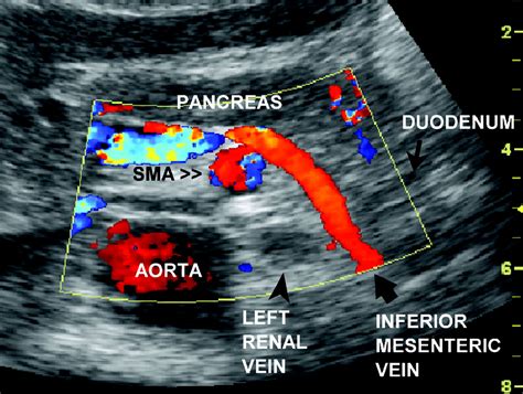 Inferior Mesenteric Vein: Gray-Scale And Doppler, 60% OFF