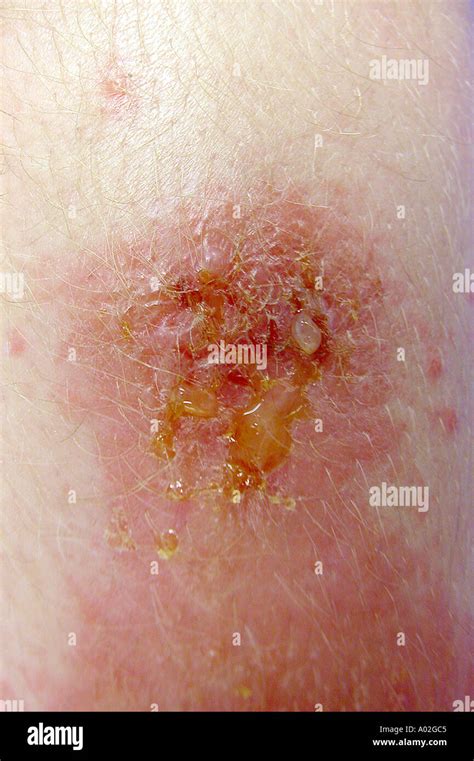 poison ivy rash Stock Photo - Alamy