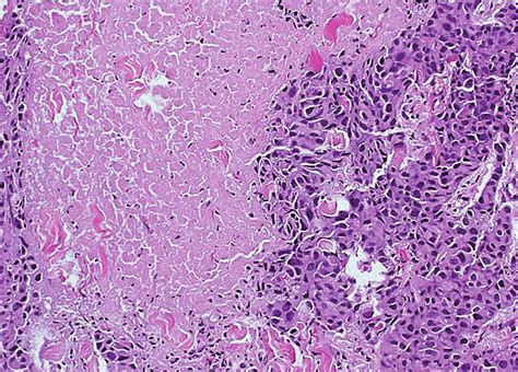 Histopathological image of invasive ductal carcinoma of no special type... | Download Scientific ...