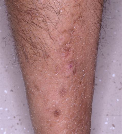 Diabetic dermopathy (Pigmented pretibial patches of diabetes mellitus) - Dermatology Advisor