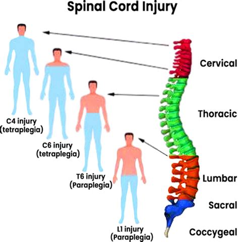 Quadriplegia or tetraplegia meaning, causes, symptoms, diagnosis ...