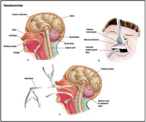 Hypophysectomy - procedure, recovery, blood, removal, complications ...