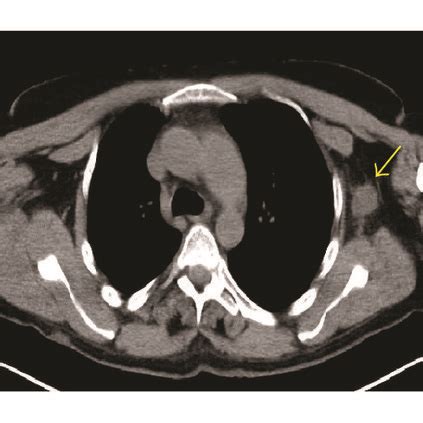 Treatment effect of an axillary MPNST following neoadjuvant... | Download Scientific Diagram