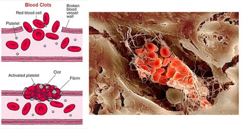 Blood clotting - Biology Notes for IGCSE 2014