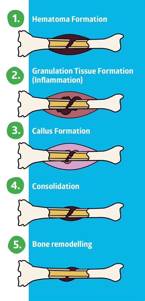 Stages Of Bone Fracture Healing