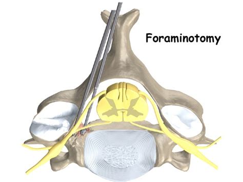 Lumbar Foraminotomy- Facetectomy Surgery in Pune : Dr. Rahul Chaudhari