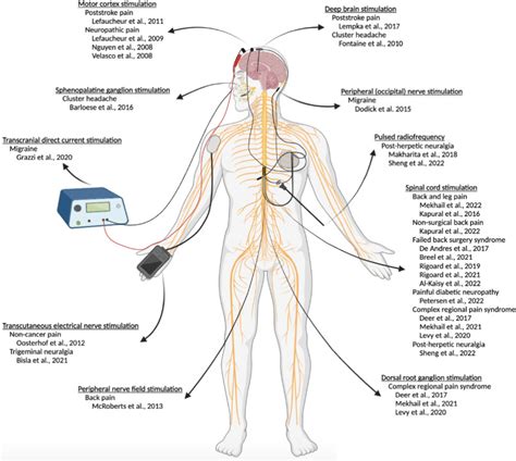 Neurostimulation for Chronic Pain: A Systematic Review of High-Quality Randomized Controlled ...