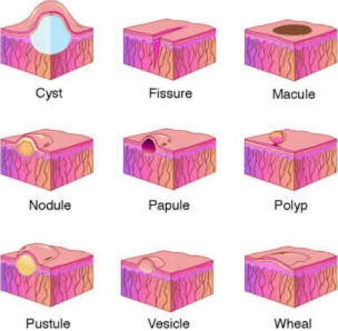 SKIN LESION: Cyst, Fissure, Macule, Nodule, Papule, Polyp, Pustule, Vesicle, Wheal | Nurse ...