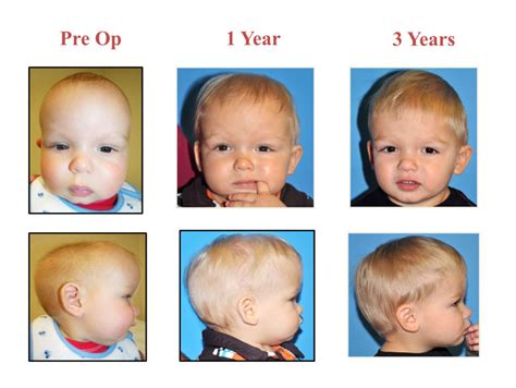 Craniosynostosis