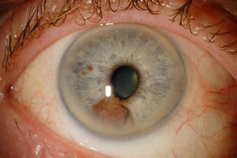 Os 7 Principais Sintomas do Câncer de Olho | Dicas de Musculação